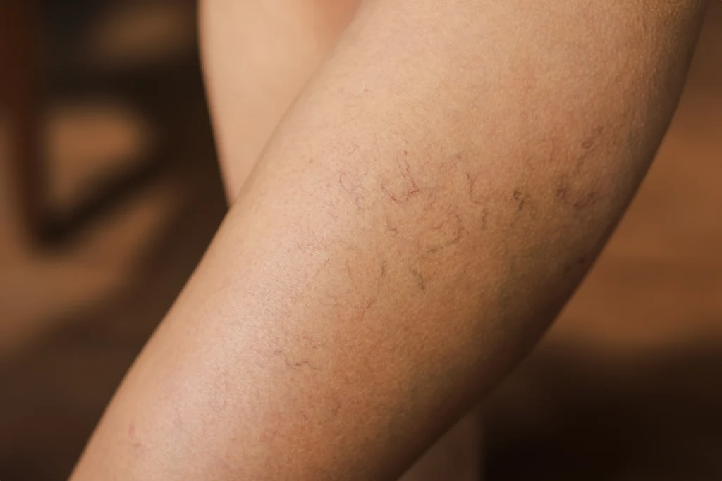 Say Goodbye to Spider Veins at Maple Lawn Vein Clinic