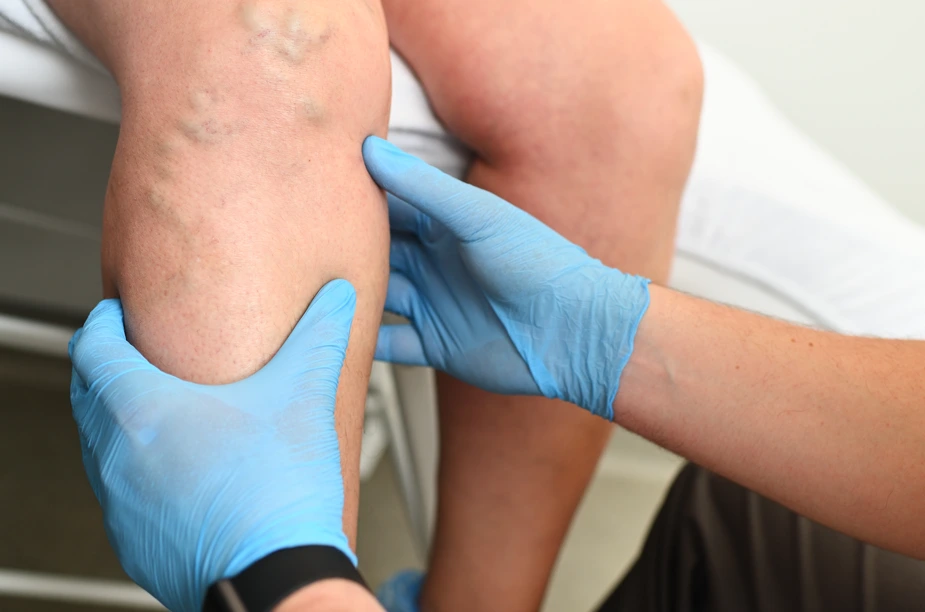 Say Goodbye to Venous Insufficiency in Hamden, CT